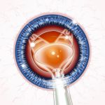 illus phaco Bausch & Lomb