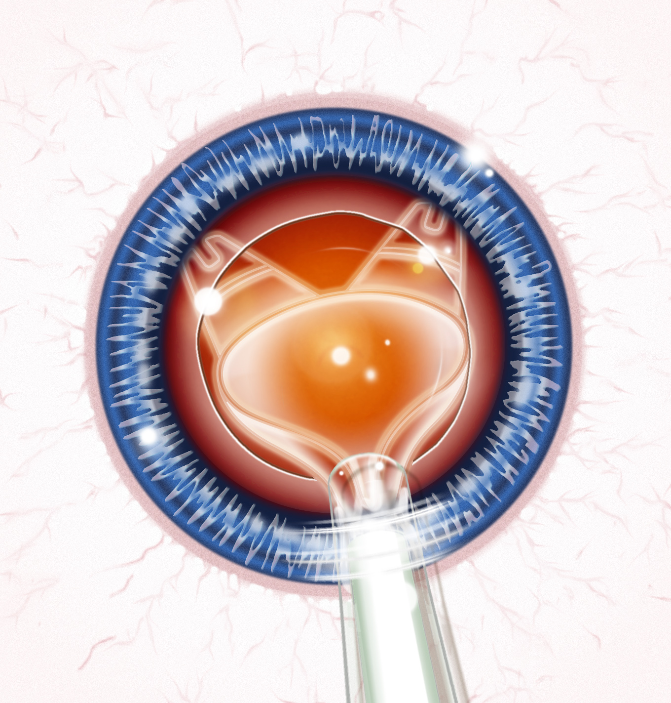 illus-phaco-bausch-lomb